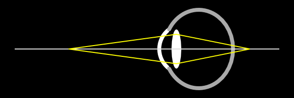 Hyperopes Auge ohne Akkommodation für ein Objekt in der Nähe