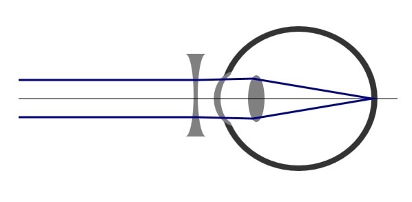 Kurzsichtiges Auge mit optischer Korrektur - Druckversion