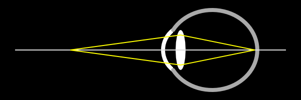 Myopes Auge ohne Akkommodation für ein Objekt in der Nähe
