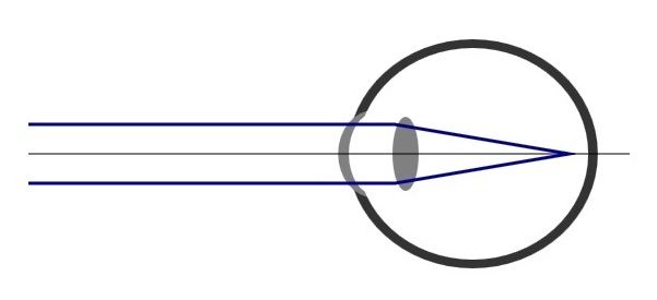Kurzsichtigkeit Druckversion